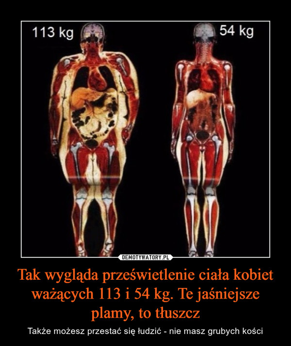 Tak wygląda prześwietlenie ciała kobiet ważących 113 i 54 kg. Te jaśniejsze plamy, to tłuszcz
