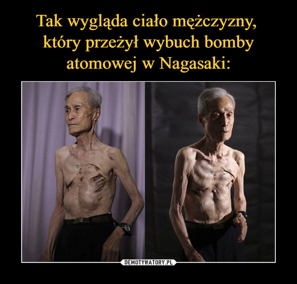 Tak wygląda ciało mężczyzny, 
który przeżył wybuch bomby atomowej w Nagasaki: