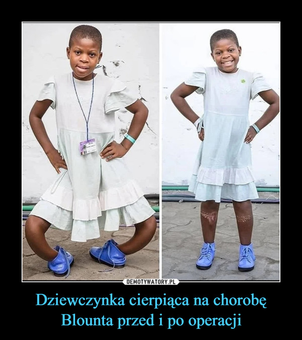 Dziewczynka cierpiąca na chorobę Blounta przed i po operacji –  